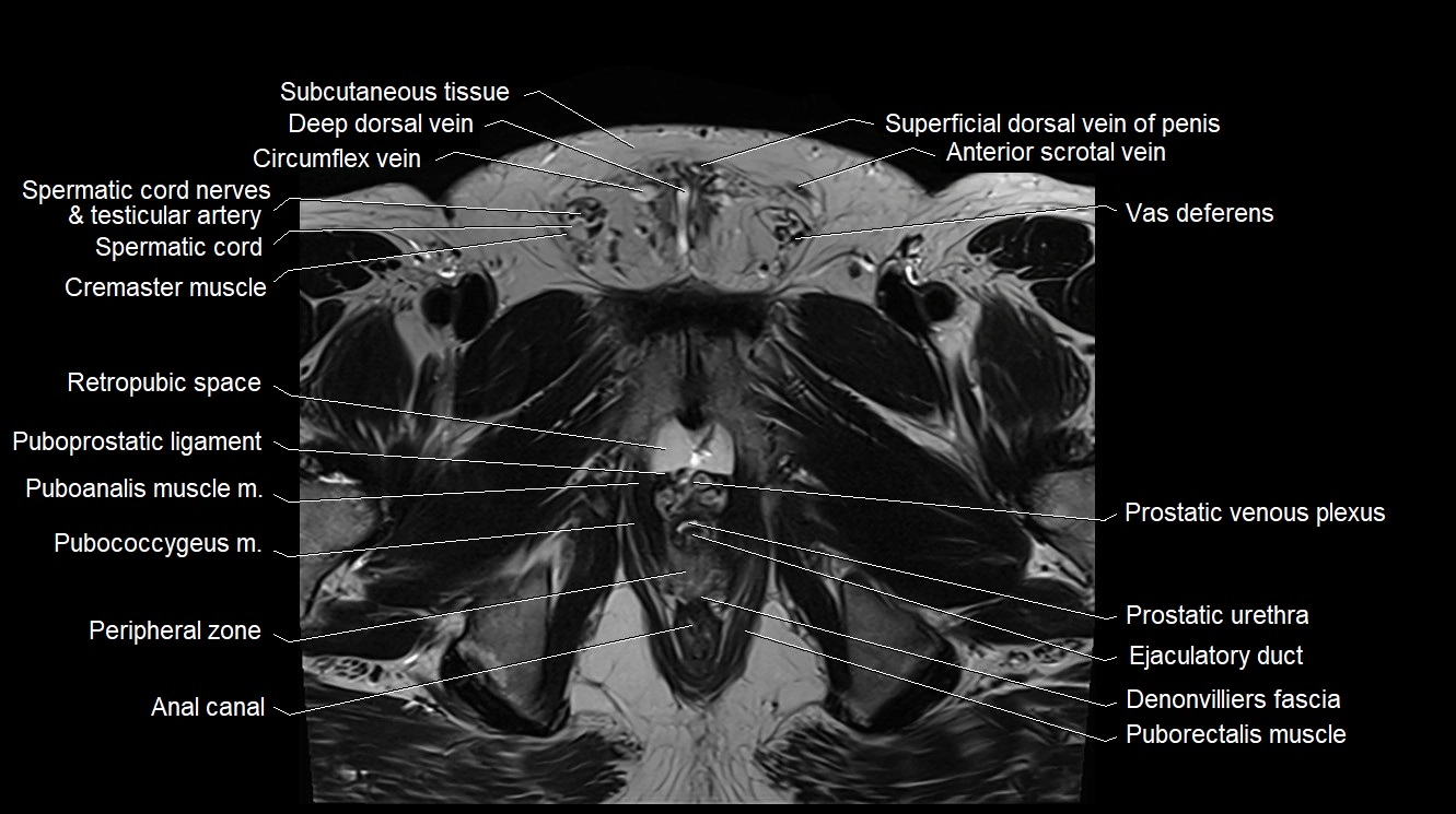 MRI 3T scrotum and penis axial cross sectional anatomy image 12.webp